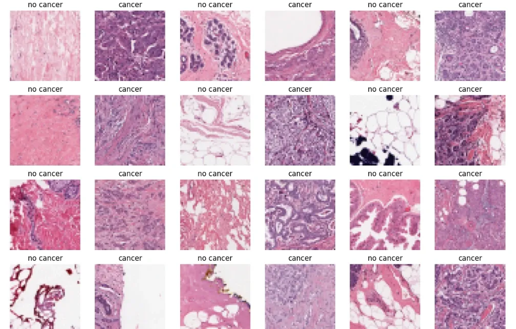 Breast Cancer Detection using CNN