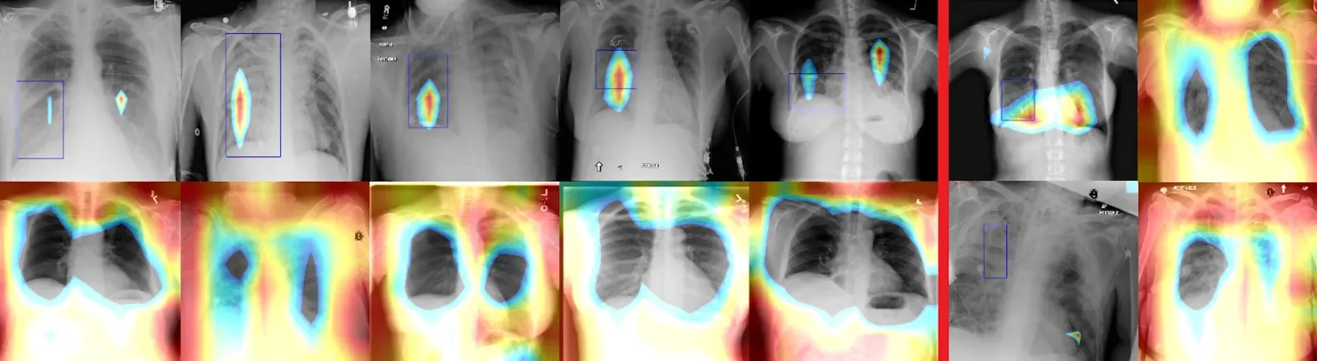 Beginner's guide to building a pneumonia detection model with ML